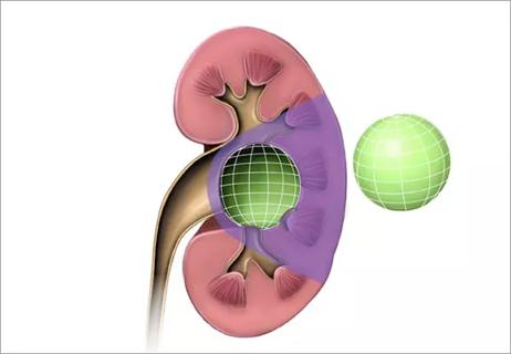 650x450exophytic tumors