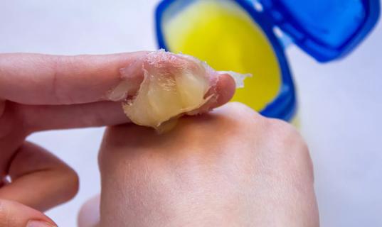 Petroleum jelly being applied to a hand