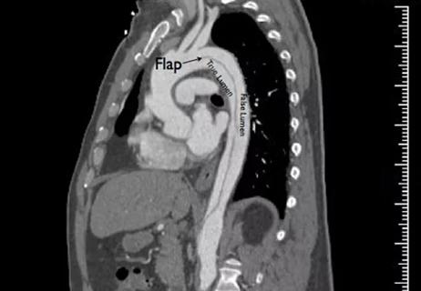 16-HRT-1024-TypeB-Aortic-Dissection-CQD-650&#215;450