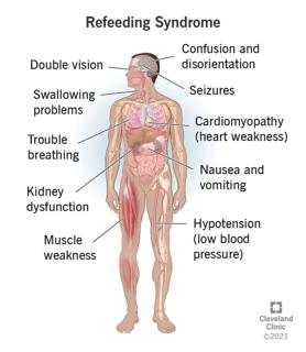 Refeeding syndrome is a serious but preventable condition that occurs when malnourished people are fed too quickly.