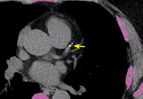 18-HRT-5875_Calcium-scoring_650x450