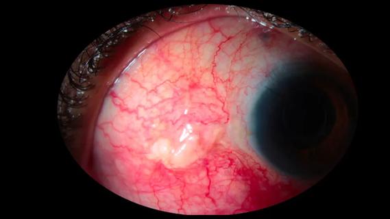 Conjunctival keloid in patient's eye