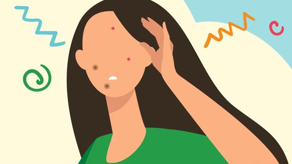 Person with pimple patches on their pimples