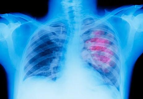 Lung cancer