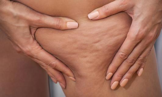 Hands squeezing a leg to show cellulite