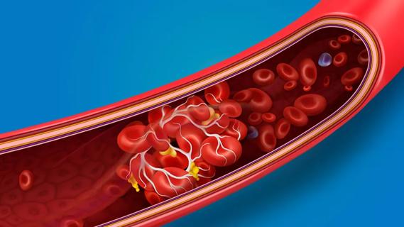 blood clot inside an artery