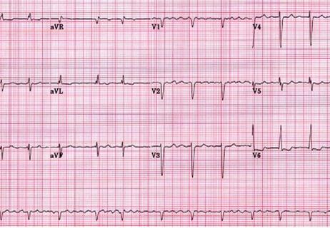 AF ECG Tracing