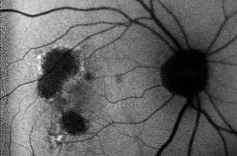 A closeup of black blood vessels and large dark spots on a gray background