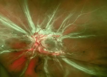 Retinal fundus photo of proliferative diabetic retinopathy