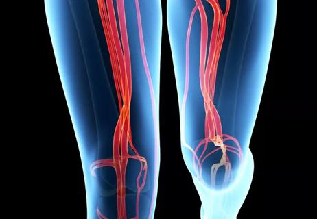 ILLUMENATE: Paclitaxel-Coated Balloon Outperforms PTA in Superficial Femoral Artery Disease