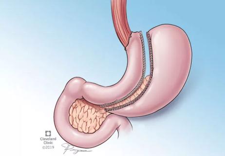 sleeve gastrectomy