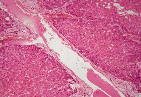 Human liver tissue with Amyloidosis under a microscope.