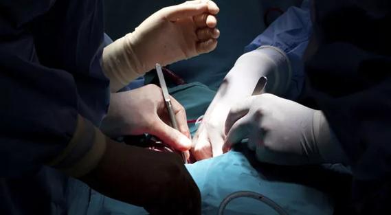 Coronary Artery Bypass Grafting (CABG)