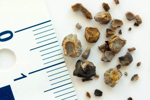 Kidney stones