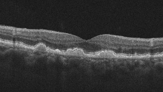 OCT scan showing dry AMD