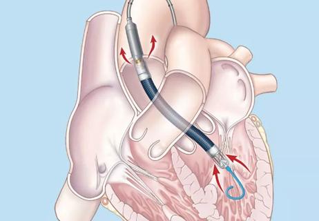 20-NEU-1951118_Impella-temporary-LVAD_650x450_ (1)