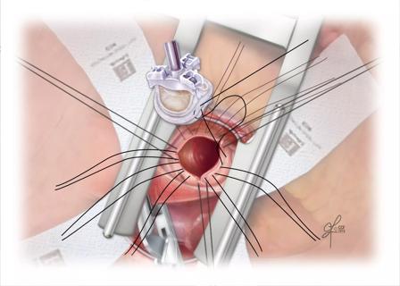 AVR-Prosthesis Suturing