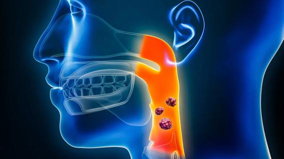 HPV associated oropharyngeal-cancers