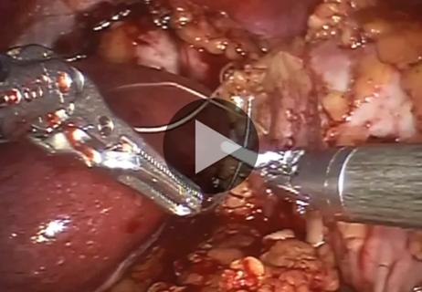 805x Inset 650&#215;450-Concurrent-Robotic-Partial-Nephrectomy-and-Pyelolithotomy