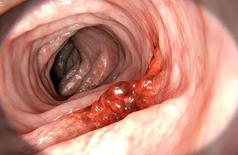 650&#215;450-Colorectal-Cancer-GettyImages-646161486