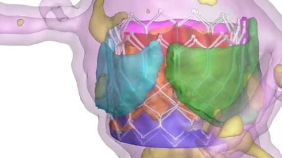 colorful imaging model of a heart valve procedure