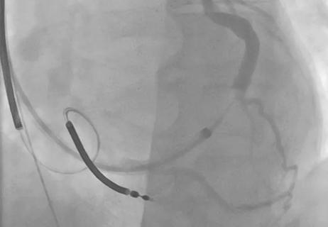 Nonresponse to CRT: A Case Study in Systematic Troubleshooting