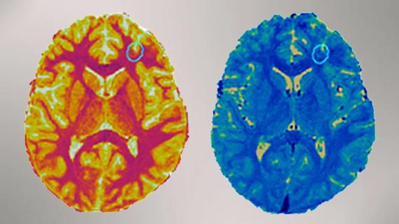 two brightly colored brain scans side by side