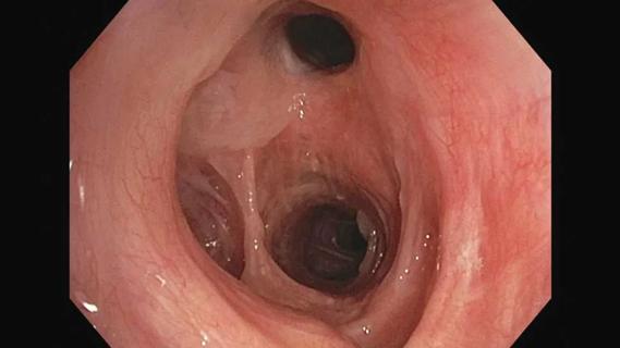 Bronchoscopy showing silicone stent