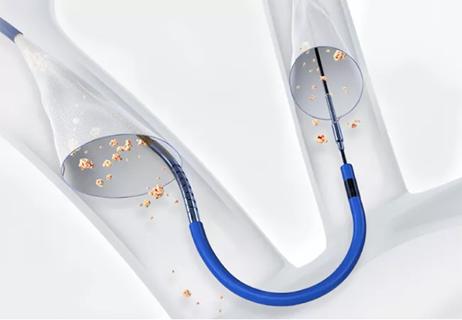 Advances Have Put Carotid Artery Stenting on Par With Advances Have Put Carotid Artery Stenting on Par With