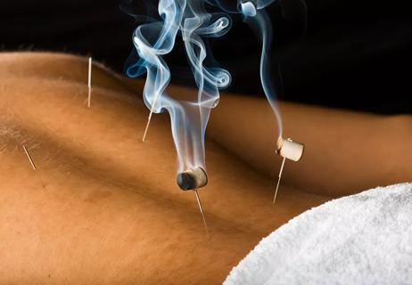 moxibustion on acupuncture needles in skin on adult's back