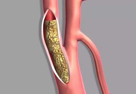 20-HVI-1998312_carotid-endarterectomy_650x450