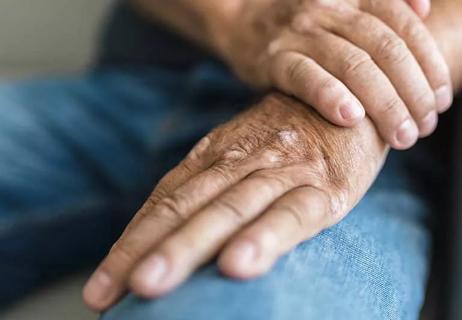 8 Ways Psoriatic Arthritis Affects the Nails - GoodRx