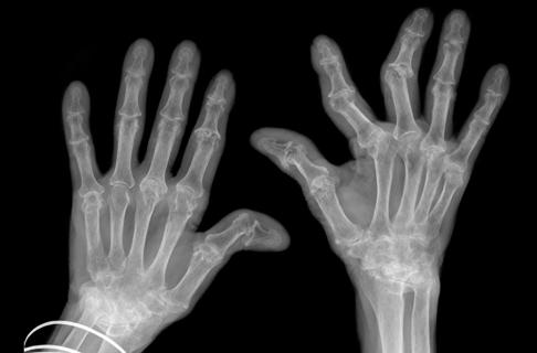 hand xrays showing advanced rheumatoid arthritis