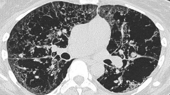 Lymphangioleiomyomatosis