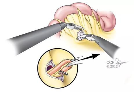 650&#215;450-ILEAL-CONDUIT_pull_12-76737