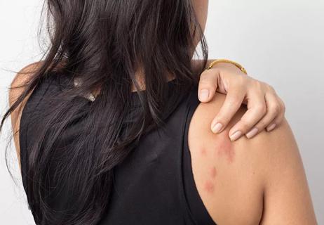 Woman itching hives on shoulder