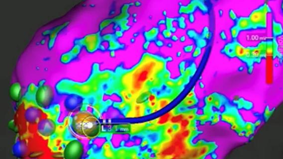 map of the heart for use in cardiac ablation with catheter atop the map