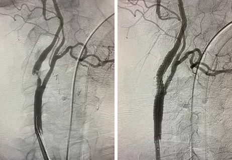 images of carotid bifurcation before and after TCAR