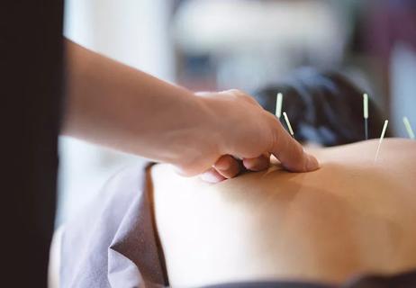 Closeup of a practicioner's hands placing acupuncture needles into a patient's back