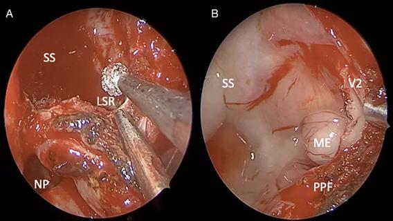 endoscopic modified transpterygoid approach (MTPA)