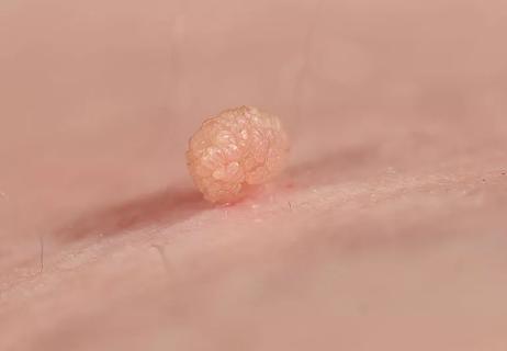 Skin tag