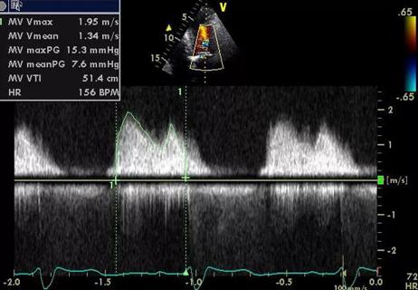 Case Study: Advanced Multilayer Cardiac Disease from Prior Thoracic Radiation