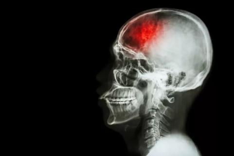 Stroke concept