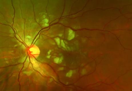 Vaso-occlusive retinopathy