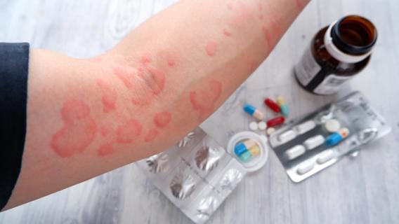 Hives on a person's arm from an allergic reaction to medication