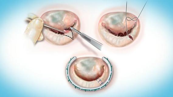 three-panel illustration of a mitral valve operation