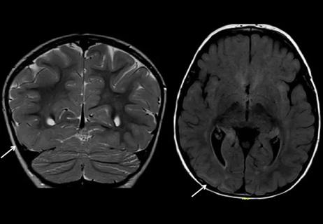 Case Study: A Toddler With Seizures, Hypsarrhythmia and an Evolving MRI