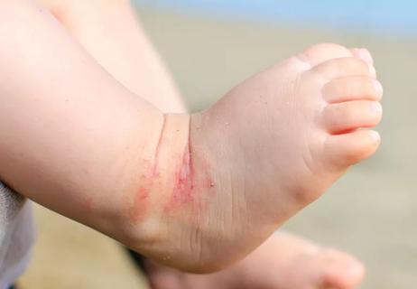 Close up of a baby's foot that shows eczema irritated skin.