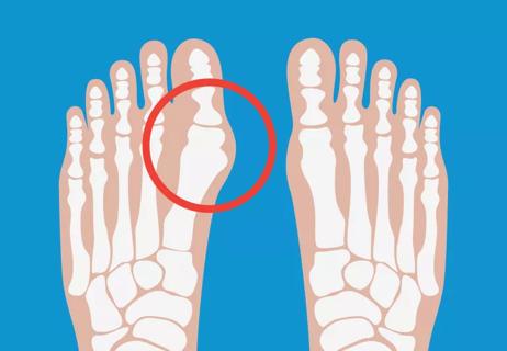 7 Ways to Ease Bunion Pain Without Surgery