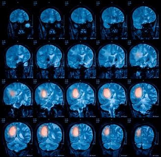 Magnetic resonance imaging (MRI) of the brain, brain tumor